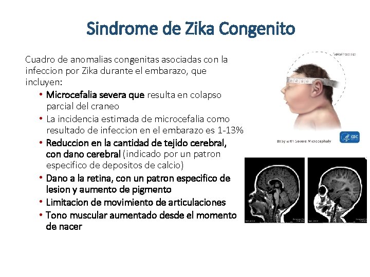 Sindrome de Zika Congenito Cuadro de anomalias congenitas asociadas con la infeccion por Zika