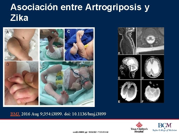 Asociación entre Artrogriposis y Zika BMJ. 2016 Aug 9; 354: i 3899. doi: 10.