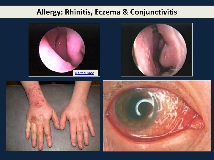 Allergy: Rhinitis, Eczema & Conjunctivitis Normal nose 