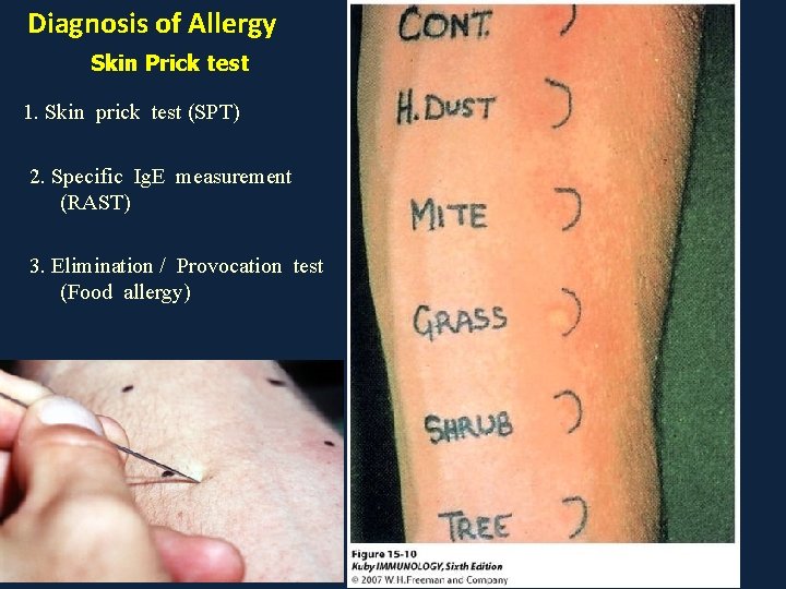 Diagnosis of Allergy Skin Prick test 1. Skin prick test (SPT) 2. Specific Ig.