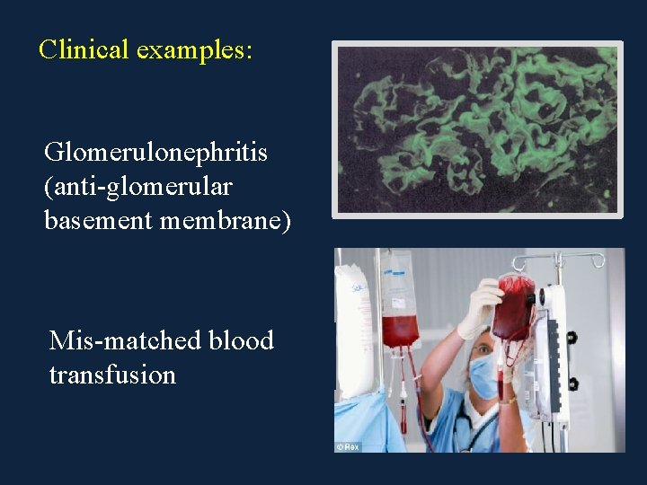 Clinical examples: Glomerulonephritis (anti-glomerular basement membrane) Mis-matched blood transfusion 