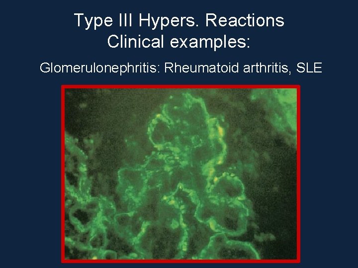 Type III Hypers. Reactions Clinical examples: Glomerulonephritis: Rheumatoid arthritis, SLE 