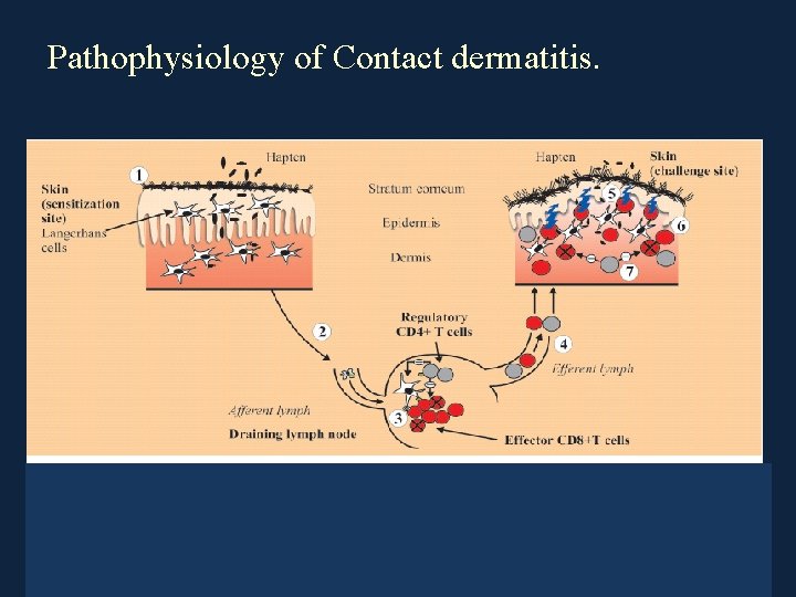 Pathophysiology of Contact dermatitis. 