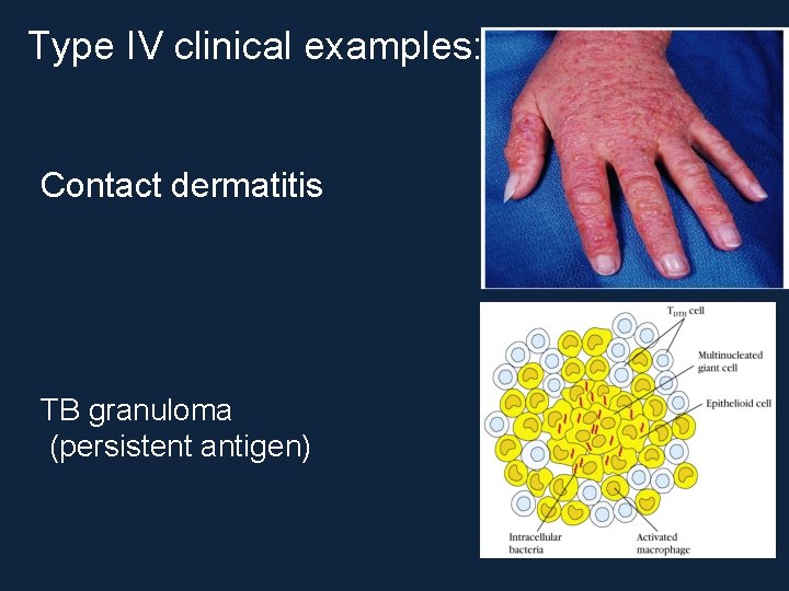 Type IV clinical examples: Contact dermatitis TB granuloma (persistent antigen) 