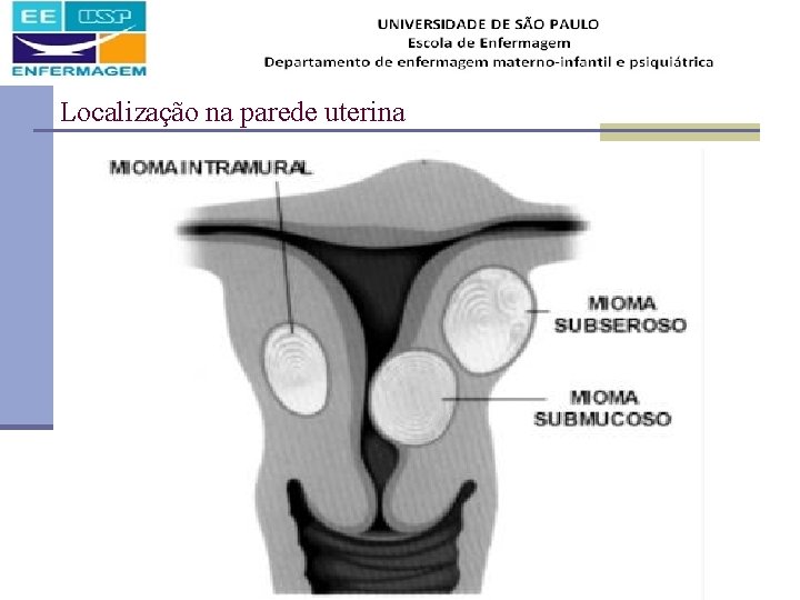 Localização na parede uterina 