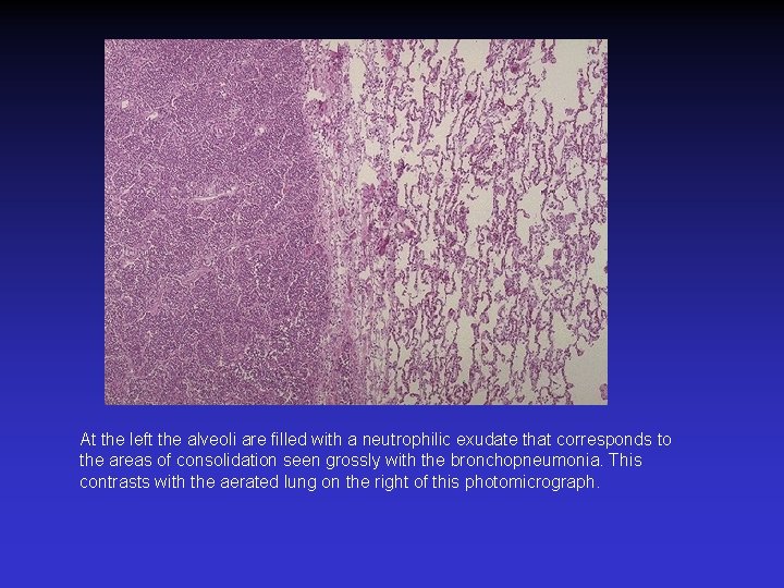 At the left the alveoli are filled with a neutrophilic exudate that corresponds to