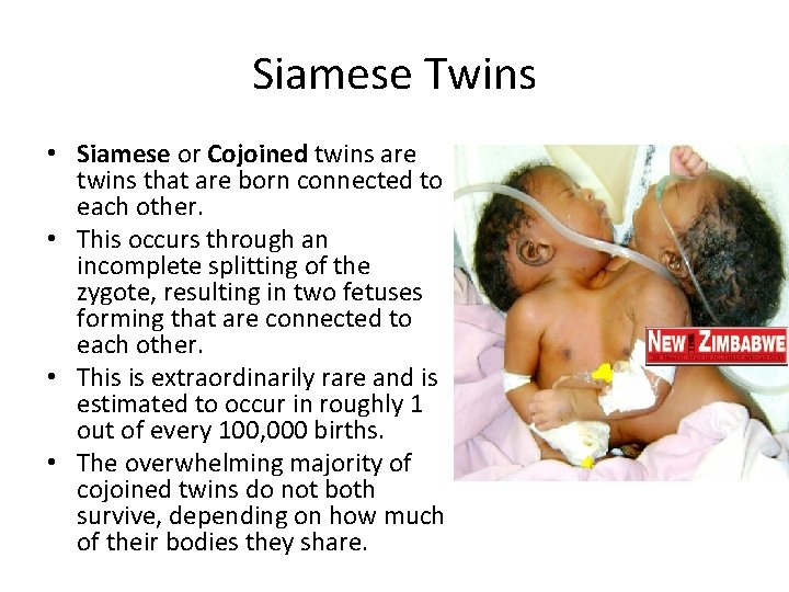 Siamese Twins • Siamese or Cojoined twins are twins that are born connected to Siamese Twins • Siamese or Cojoined twins are twins that are born connected to