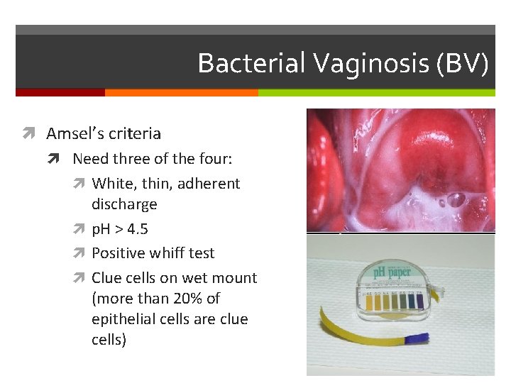 Bacterial Vaginosis (BV) Amsel’s criteria Need three of the four: White, thin, adherent discharge