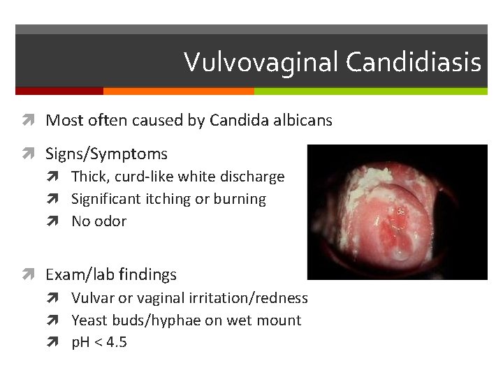 Vulvovaginal Candidiasis Most often caused by Candida albicans Signs/Symptoms Thick, curd-like white discharge Significant