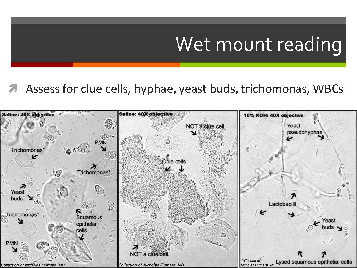 Wet mount reading Assess for clue cells, hyphae, yeast buds, trichomonas, WBCs 