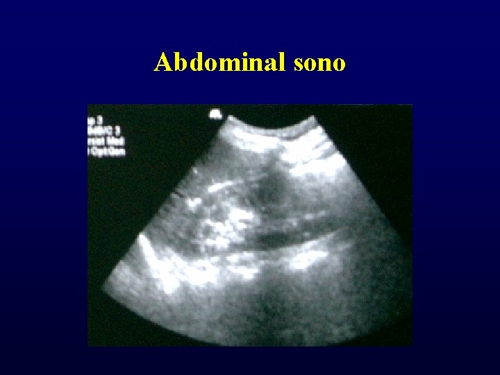 Abdominal sono Abdominal sono
