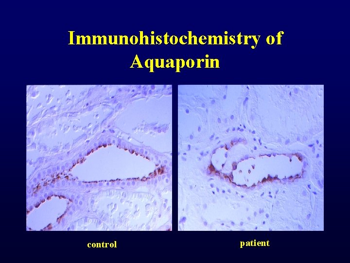 Immunohistochemistry of Aquaporin control patient Immunohistochemistry of Aquaporin control patient