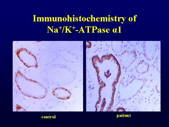 Immunohistochemistry of Na+/K+-ATPase α 1 control patient Immunohistochemistry of Na+/K+-ATPase α 1 control patient