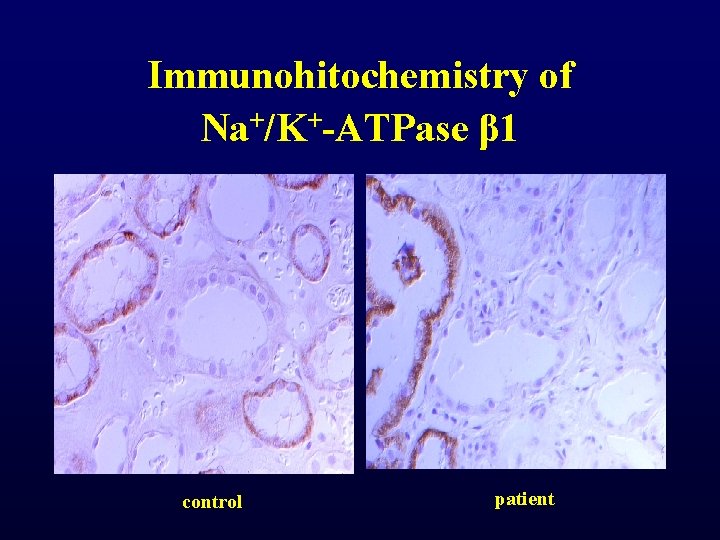 Immunohitochemistry of Na+/K+-ATPase β 1 control patient Immunohitochemistry of Na+/K+-ATPase β 1 control patient