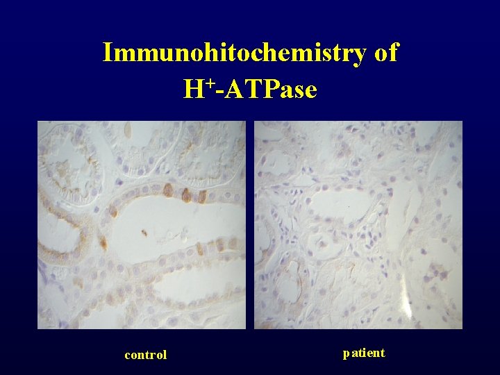 Immunohitochemistry of H+-ATPase control patient Immunohitochemistry of H+-ATPase control patient