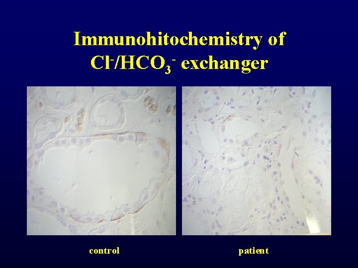 Immunohitochemistry of Cl-/HCO 3 - exchanger control patient Immunohitochemistry of Cl-/HCO 3 - exchanger control patient