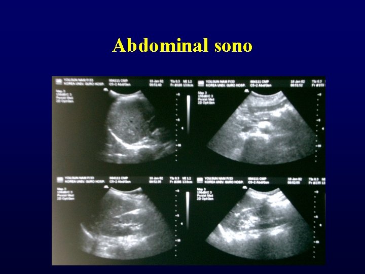 Abdominal sono Abdominal sono