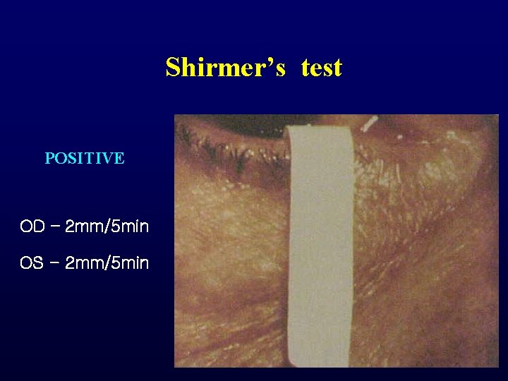 Shirmer’s test POSITIVE OD – 2 mm/5 min OS - 2 mm/5 min Shirmer’s test POSITIVE OD – 2 mm/5 min OS - 2 mm/5 min