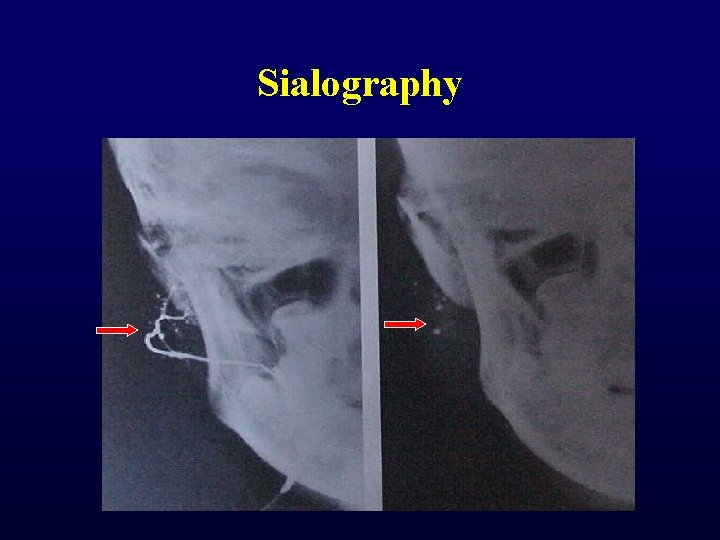 Sialography Sialography