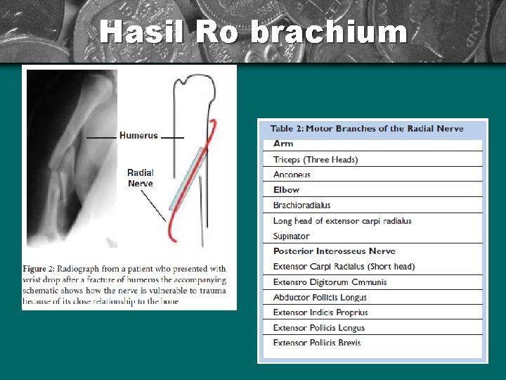 Hasil Ro brachium 