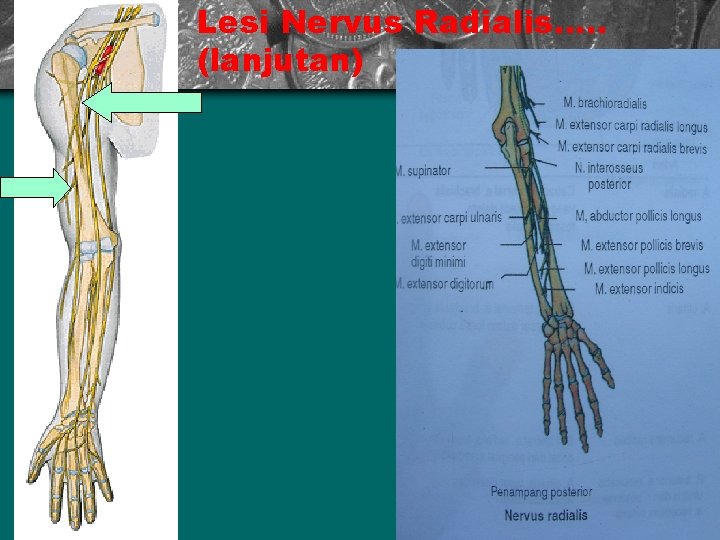 Lesi Nervus Radialis. . . (lanjutan) 