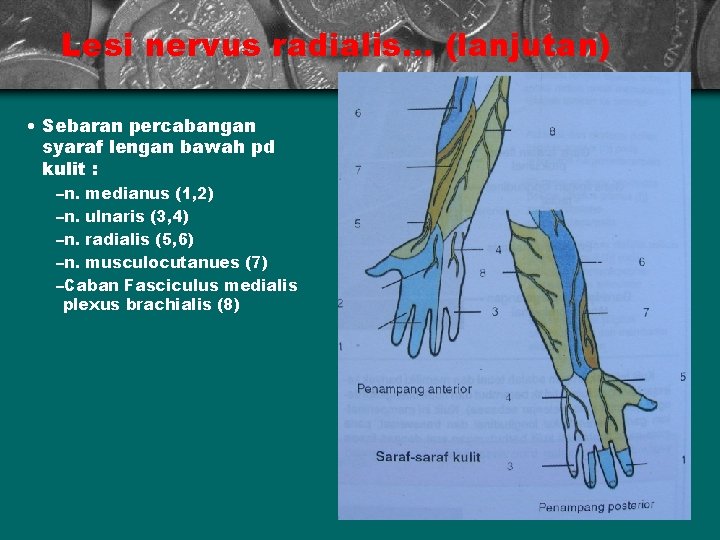 Lesi nervus radialis. . . (lanjutan) • Sebaran percabangan syaraf lengan bawah pd kulit