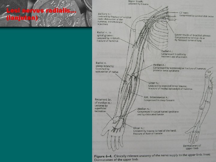 Lesi nervus radialis. . . (lanjutan) 