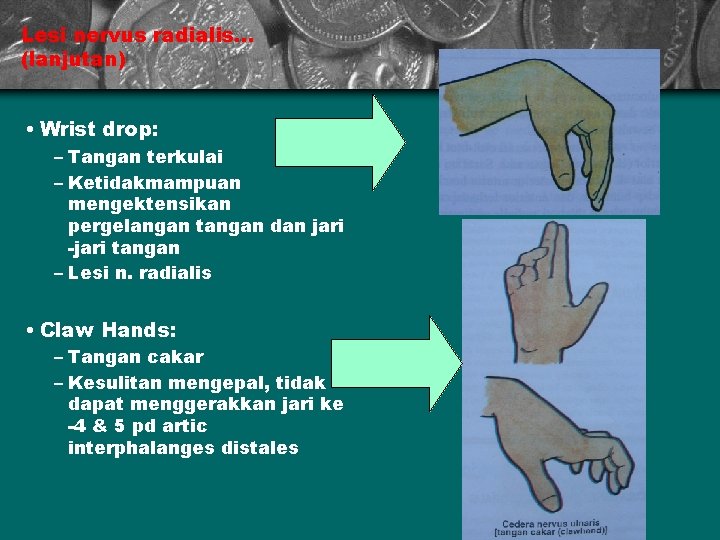 Lesi nervus radialis. . . (lanjutan) • Wrist drop: – Tangan terkulai – Ketidakmampuan