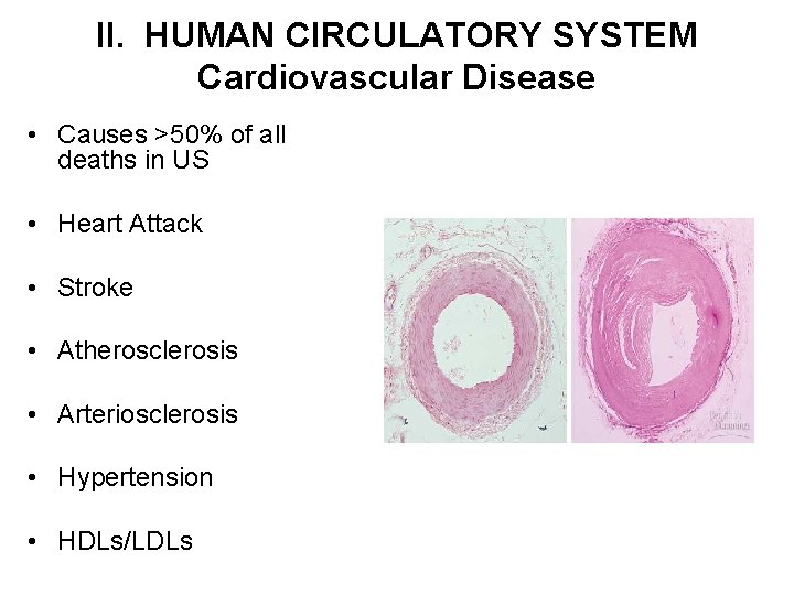 II. HUMAN CIRCULATORY SYSTEM Cardiovascular Disease • Causes >50% of all deaths in US