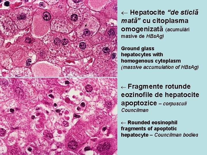 ¬ Hepatocite “de sticlă mată” cu citoplasma omogenizată (acumulări masive de HBs. Ag) Ground