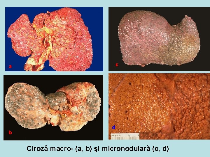 c a b d Ciroză macro- (a, b) şi micronodulară (c, d) 