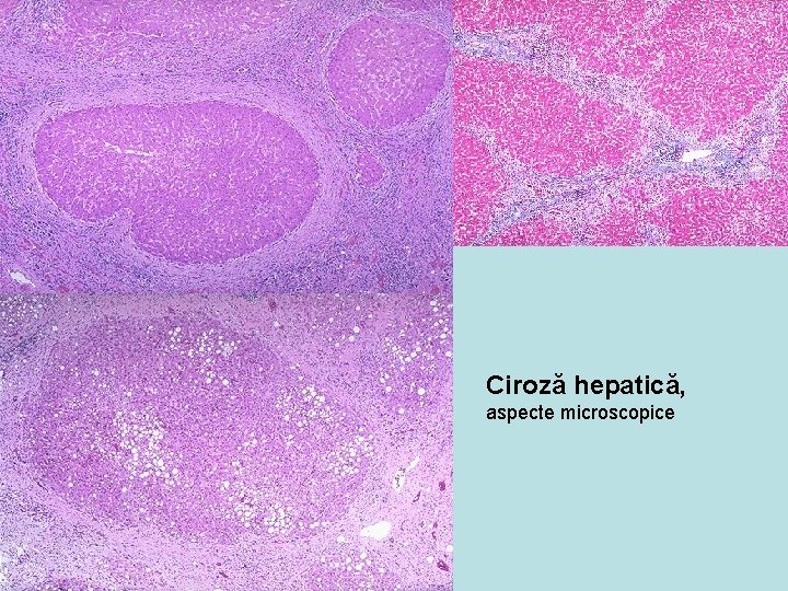 Ciroză hepatică, aspecte microscopice 