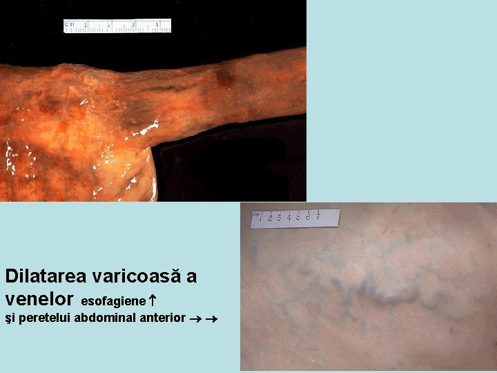 Dilatarea varicoasă a venelor esofagiene şi peretelui abdominal anterior 