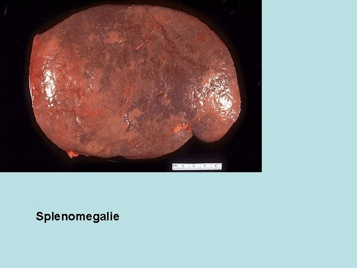 Splenomegalie 