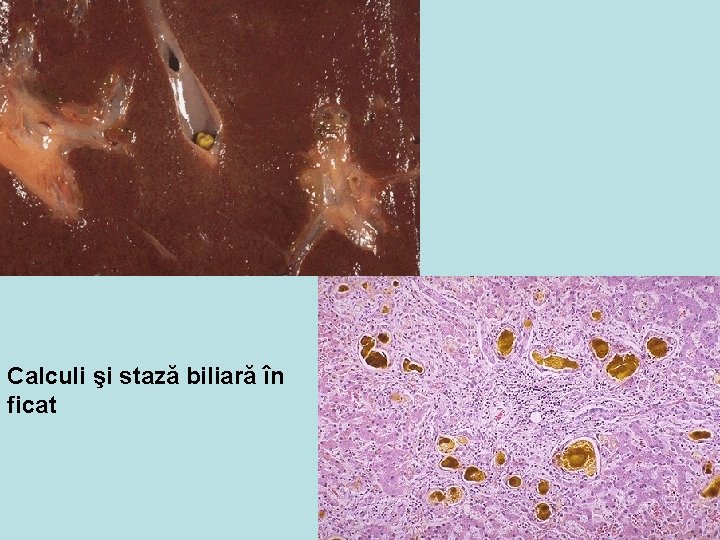 Calculi şi stază biliară în ficat 