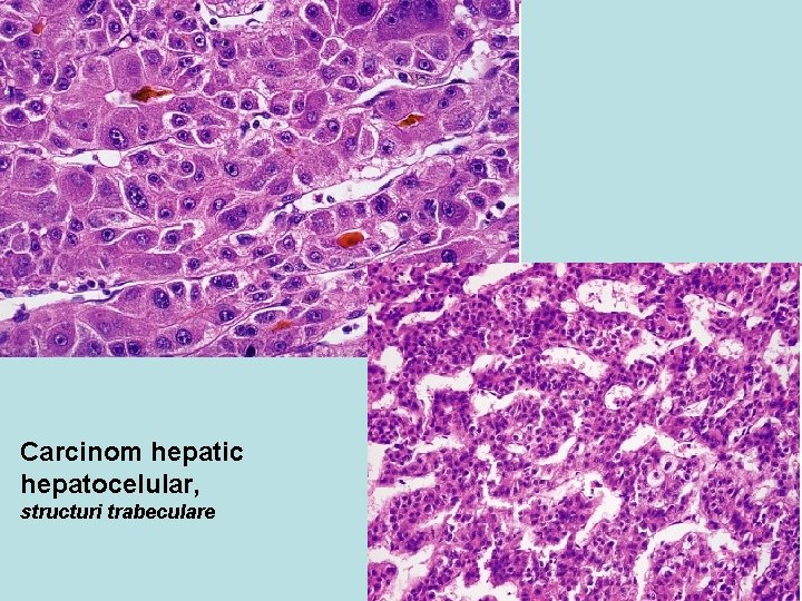 Carcinom hepatic hepatocelular, structuri trabeculare 