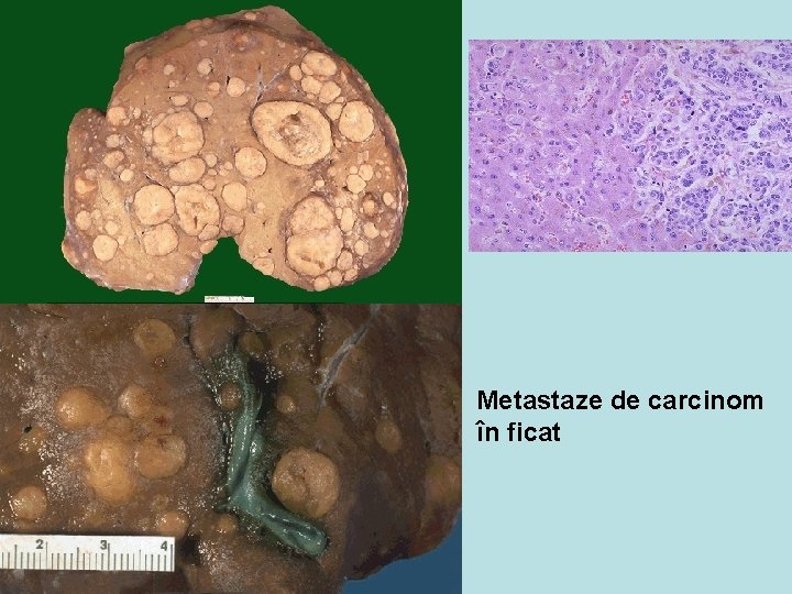 Metastaze de carcinom în ficat 