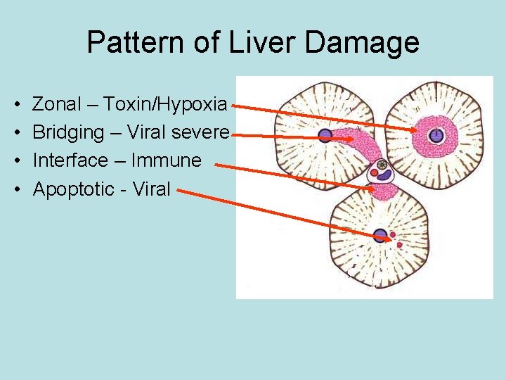 Pattern of Liver Damage • • Zonal – Toxin/Hypoxia Bridging – Viral severe Interface