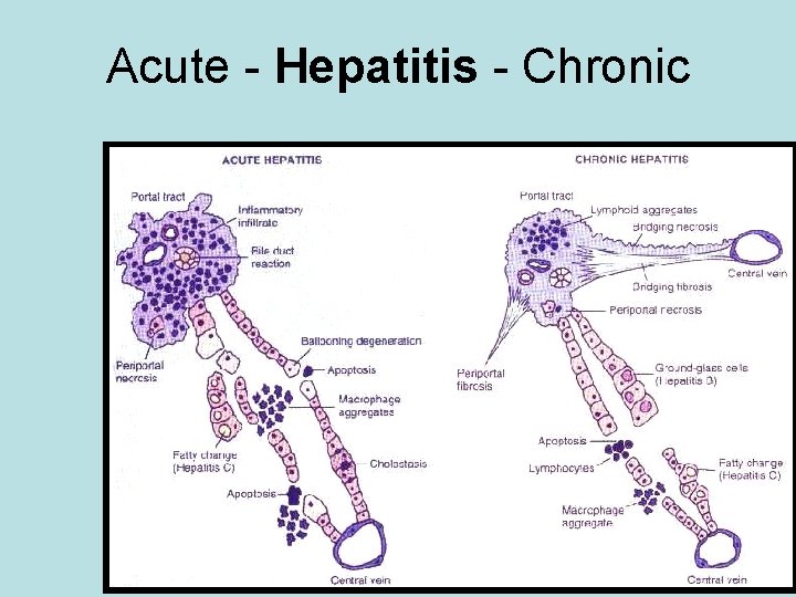Acute - Hepatitis - Chronic 