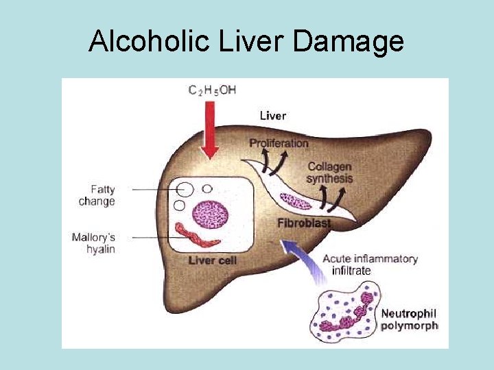Alcoholic Liver Damage 