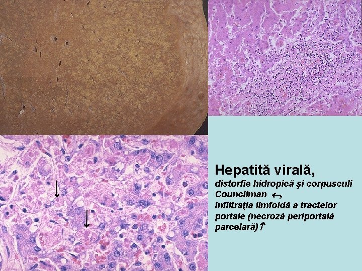 Hepatită virală, distorfie hidropică şi corpusculi Councilman , infiltraţia limfoidă a tractelor portale (necroză