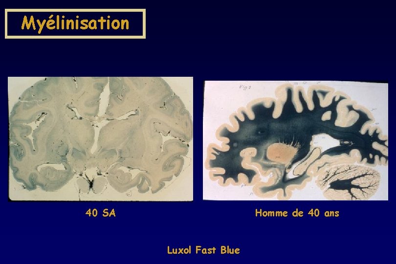 Myélinisation 40 SA Homme de 40 ans Luxol Fast Blue Myélinisation 40 SA Homme de 40 ans Luxol Fast Blue