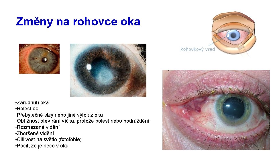 Změny na rohovce oka • Zarudnutí oka • Bolest očí • Přebytečné slzy nebo