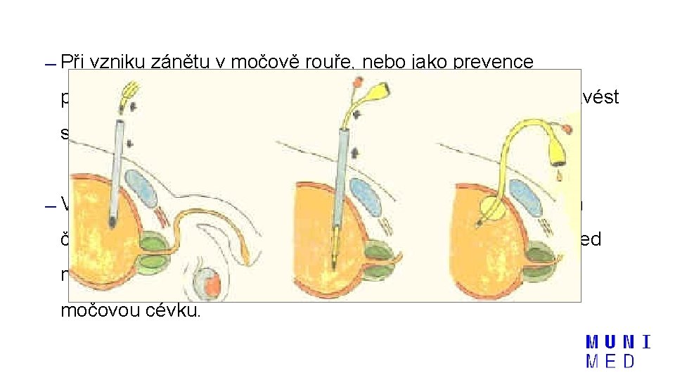  Při vzniku zánětu v močově rouře, nebo jako prevence poškození močové trubice lze