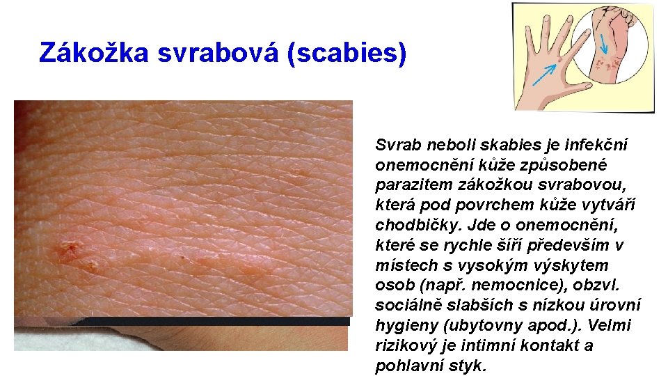 Zákožka svrabová (scabies) Svrab neboli skabies je infekční onemocnění kůže způsobené parazitem zákožkou svrabovou,