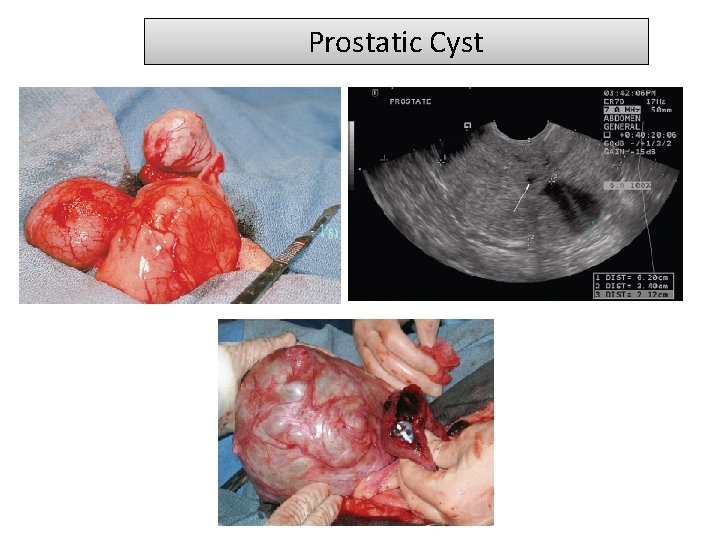 Prostatic Cyst 