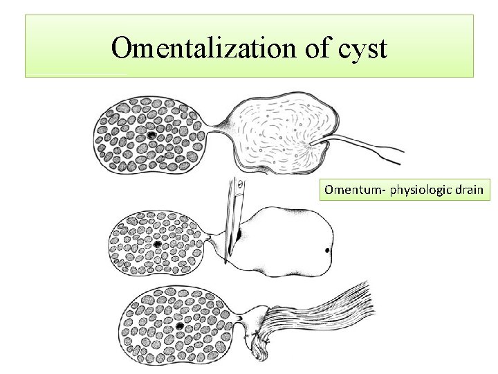 Omentalization of cyst Omentum- physiologic drain 
