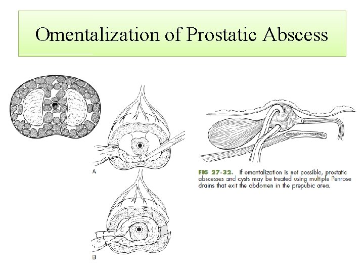 Omentalization of Prostatic Abscess 