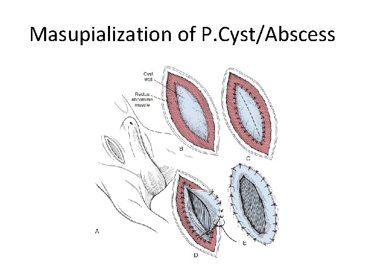 Masupialization of P. Cyst/Abscess 