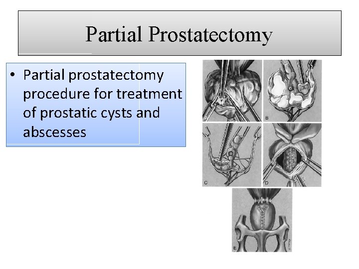 Partial Prostatectomy • Partial prostatectomy procedure for treatment of prostatic cysts and abscesses 